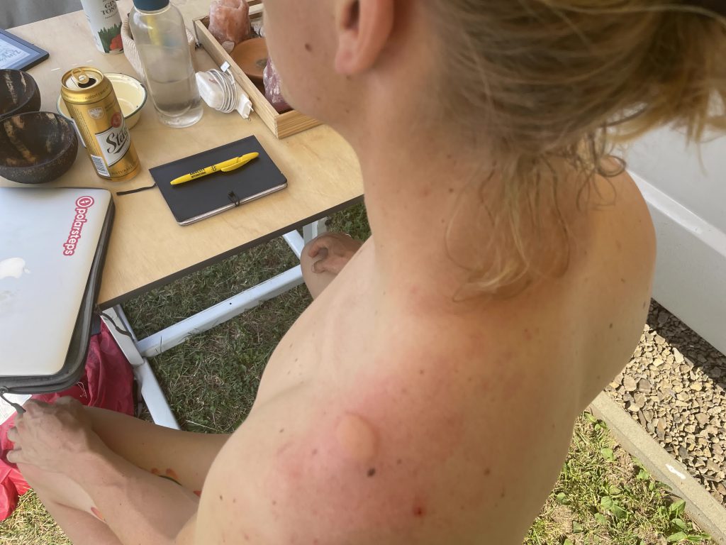 De Do's: Wat helpt wel tegen muggenbulten?_Ik Wil Hiken